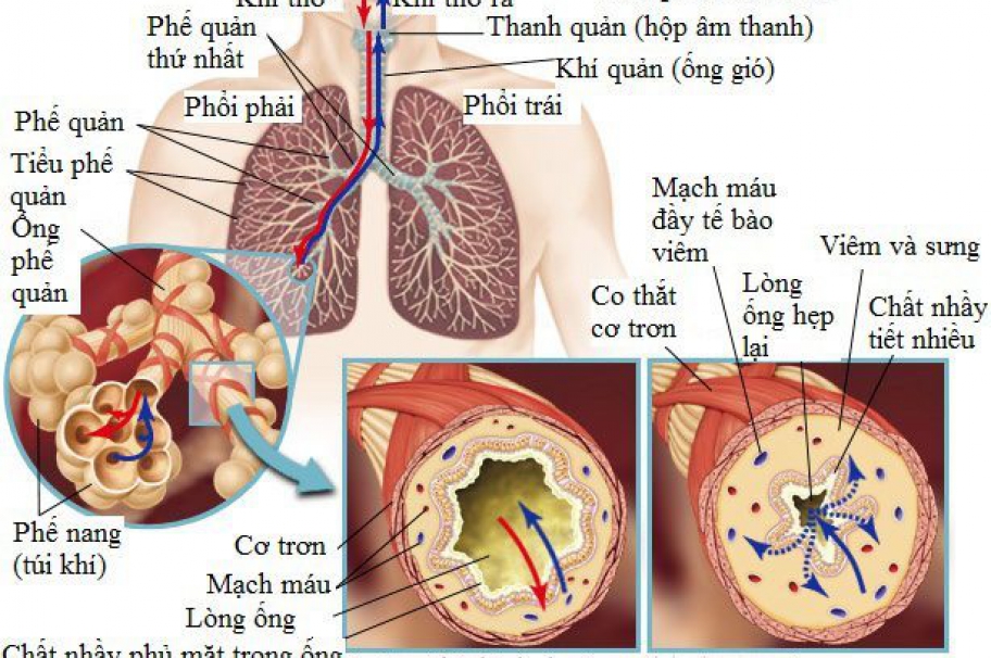 Đông y điều trị hiệu quả bệnh hen phế quản (hen suyễn)